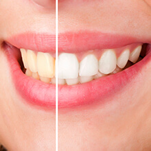 Image with half teeth before whitening and half after