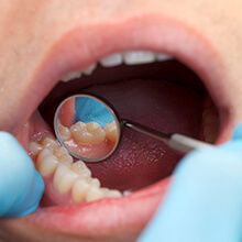 Metal-free restoration examined in dental mirror