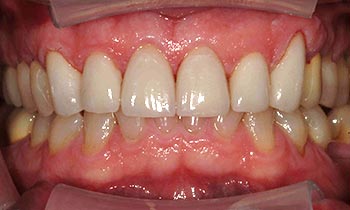 Porcelain crowns concealing yellowed and worn top teeth