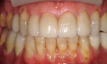 Top teeth perfected with porcelain crowns