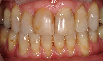 Severely discolored top teeth