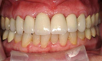 Top teeth enhanced with porcelain crowns