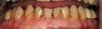 Decayed and discolored bottom teeth