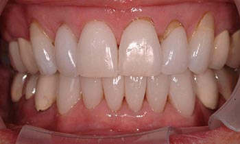 Top and bottom teeth with porcelain crowns