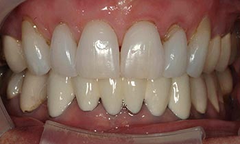Discolored top and bottom teeth