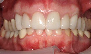 Tooth discoloration at gums concealed with porcelain crowns