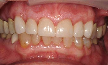 Porcelain crowns on front six teeth