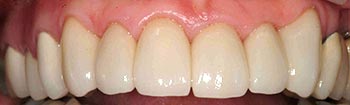Top teeth fully repaired with porcelain crowns 