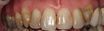 Decayed teeth and yellowed restorations