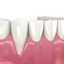 Illustration of gum recession before gum disease therapy in Westfield, NJ