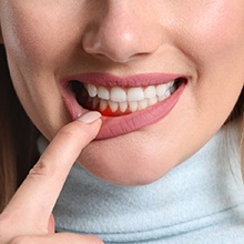 Woman showing swollen gums before gum disease therapy in Westfield, NJ