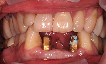 Two dental implant posts in front of mouth