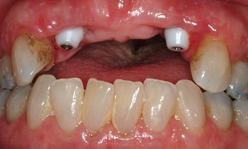 Dental implants protruding from top gum line