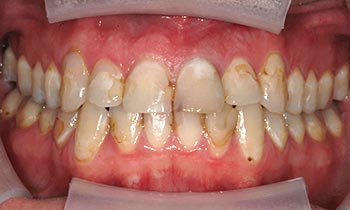 Yellowed and stained teeth