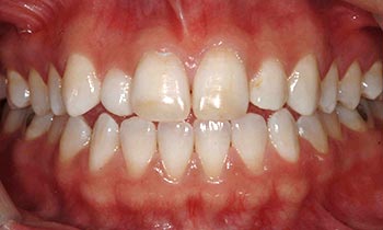 Discolored and worn front teeth