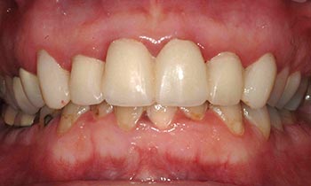 Damaged and discolored bottom teeth