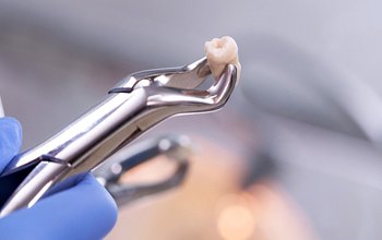 Instrument holding a tooth after tooth extractions in Westfield, NJ