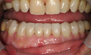 Entire smile corrected with porcelain veneers