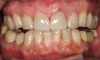 Veneers