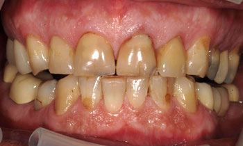 Veneers