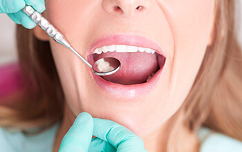 Closeup of mouth during dental exam