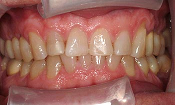 Yellow and worn top teeth