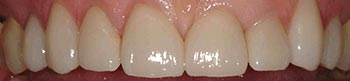 Front tooth gap concealed with porcelain crowns