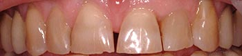 Front teeth with large gap