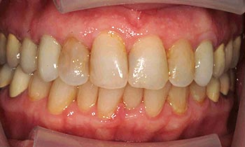 Discolored top teeth