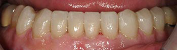 Bottom teeth enhanced with porcelain crowns