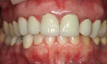 Top teeth with discoloring at gum line