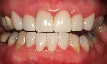 Porcelain crowns create a flawless bottom tooth line