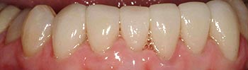 Bottom tooth line perfect with porcelain crowns