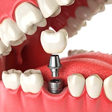 Diagram of a single tooth dental implant in Westfield being placed