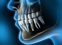 X-ray diagram of dental implants in Westfield
