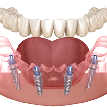 3D illustration for implant dentures