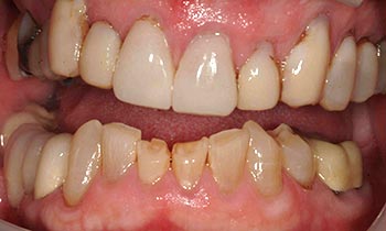 Broken bottom row of teeth