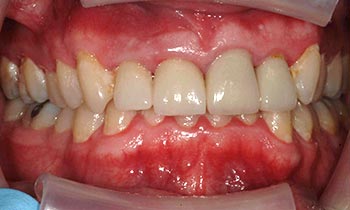 Discolored and damaged teeth with dark restorations