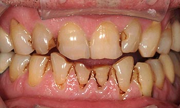 Decayed teeth with dark staining and misalignment