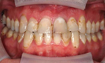 Severe dental decay discoloration and damage