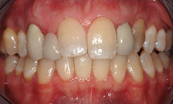 Yellow and damaged teeth