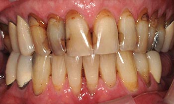 Severely decayed and dark teeth