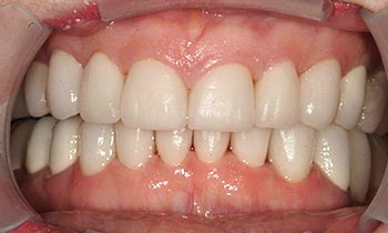 Fully transformed natural looking smile