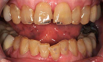 Severely decayed teeth with black spots