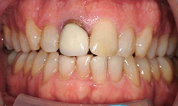 Tooth with discoloration at gums