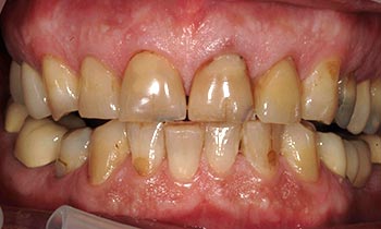 Yellowed and damaged teeth