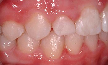 Enlarged front tooth and closed tooth gap