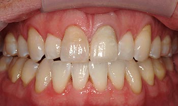 Front tooth restored to natural white coloring