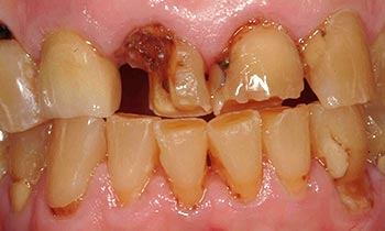 Severely decayed front teeth