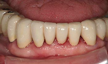 Natural looking fully repaired bottom teeth